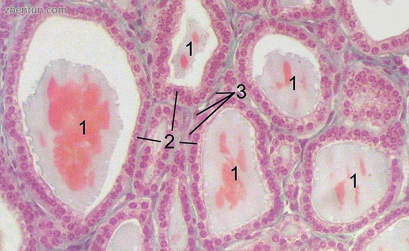 Section of a thyroid gland under the microscope. 1 follicles, 2 follicular cells, 3 endothelial cell ...