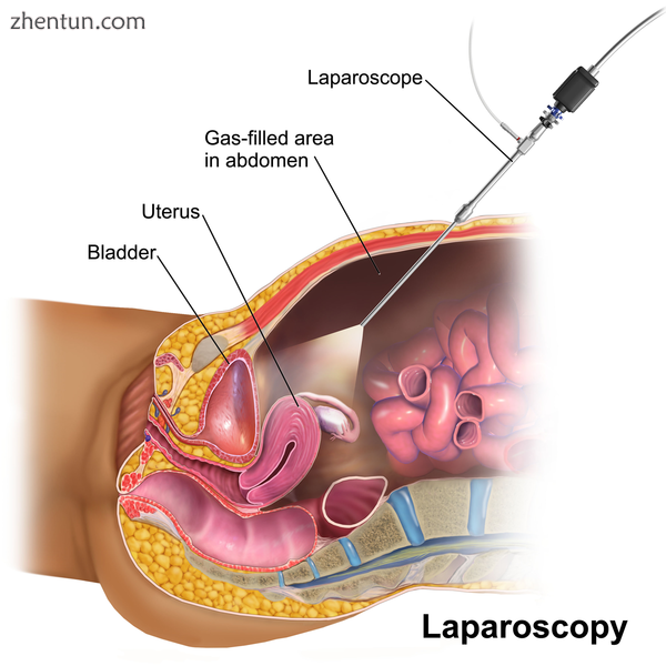 Illustration of Laparoscopy