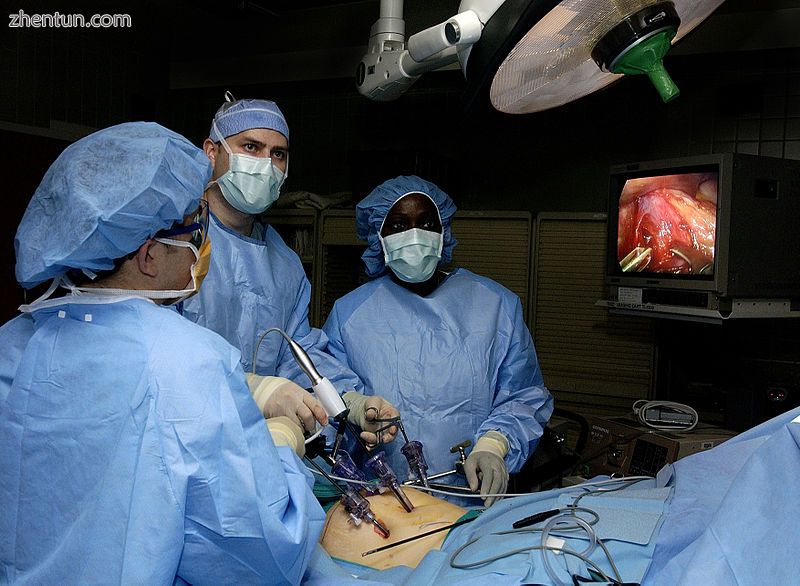 Surgeons perform laparoscopic stomach surgery.