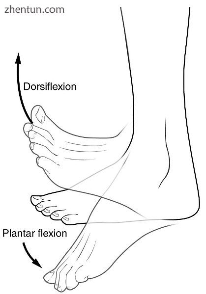 Achilles tendon tightness is a risk factor for plantar fasciitis. It can lead to decreased dorsiflex ...
