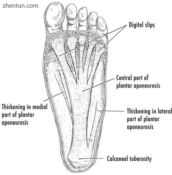 Drawing of the plantar fascia of the foot