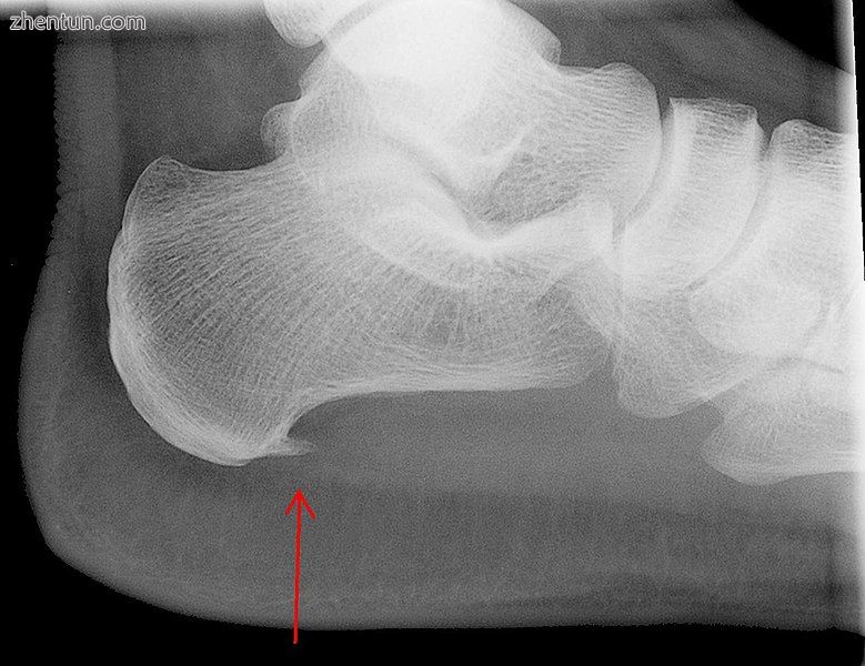 Heel bone with heel spur (red arrow)