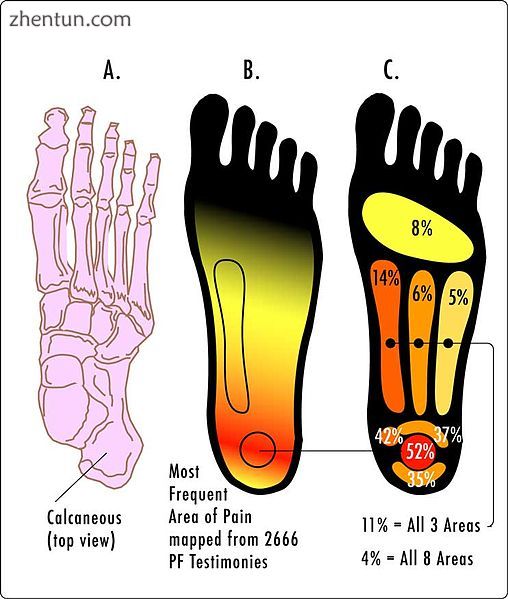 Most common areas of pain in plantar fasciitis