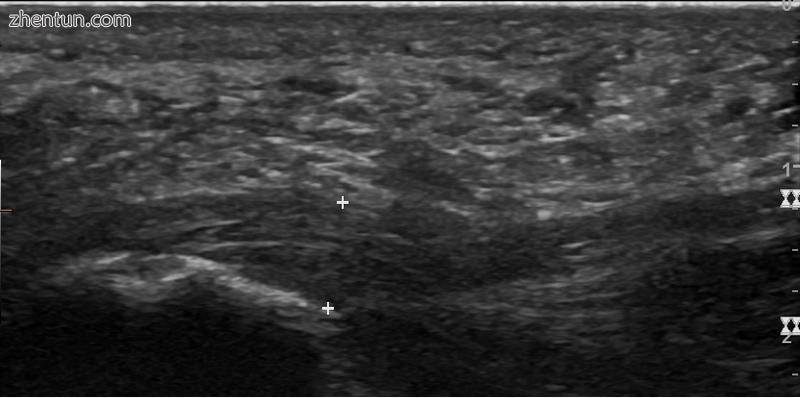 Thickened plantar fascia in ultrasound