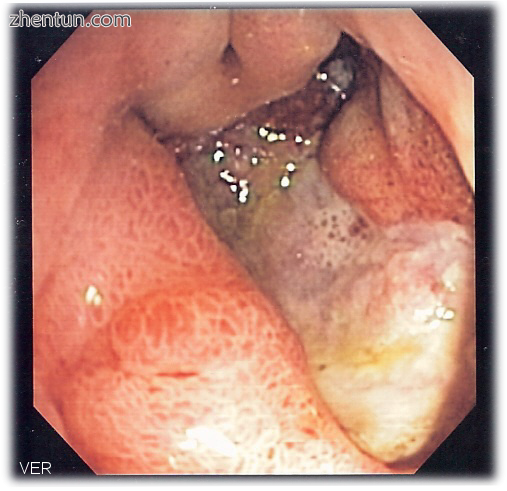 A peptic ulcer may accompany gastritis. Endoscopic image.