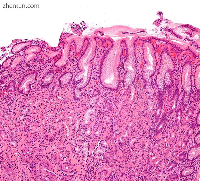 Micrograph showing gastritis. H&E stain.
