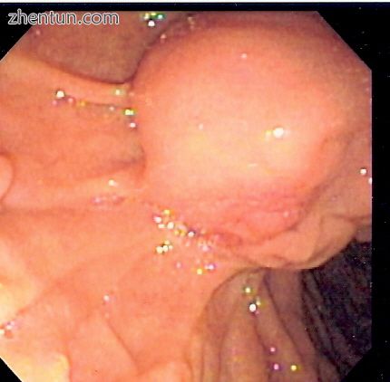 Common bile duct stone impacted at ampulla of Vater seen at time of ERCP