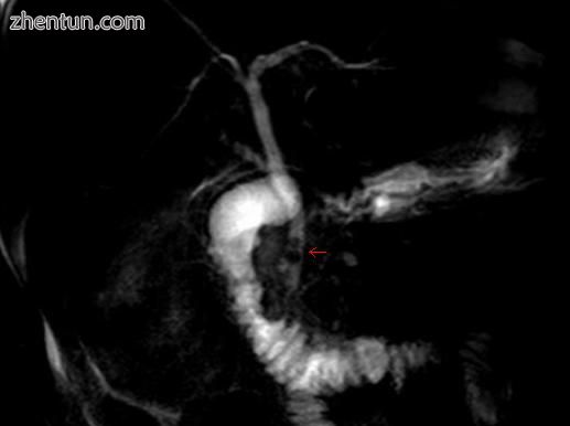 MRCP image of two stones in the distal common bile duct