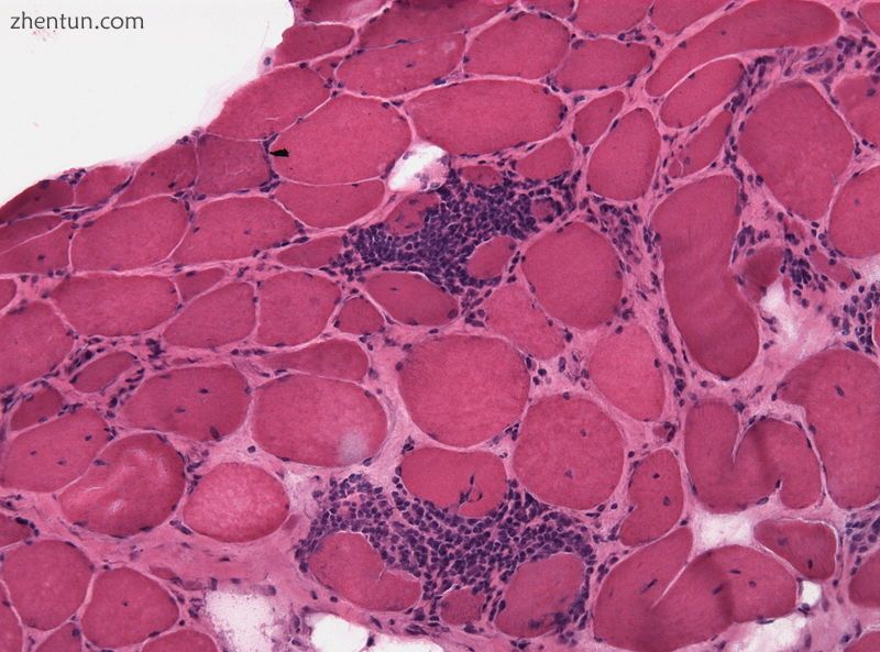 Micrograph of polymyositis. Muscle biopsy. H&E stain.