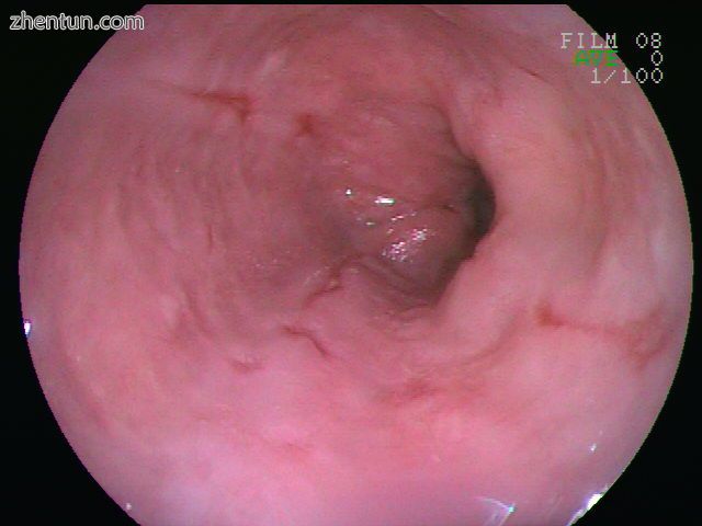 Esophageal ulcer