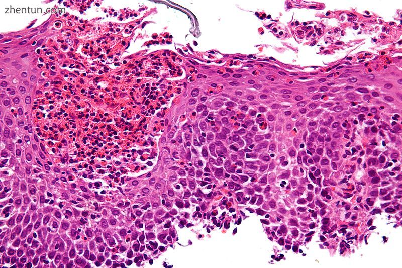 Microscopic Slide of Eosinophilic Esophagitis