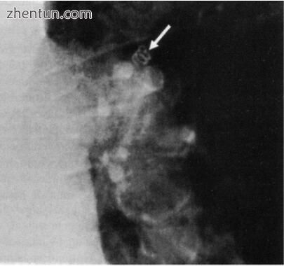 Tack in pulmonary artery after TEP (Courtesy of Jorge Cervantes, Mexico)