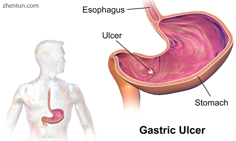 Gastric ulcer