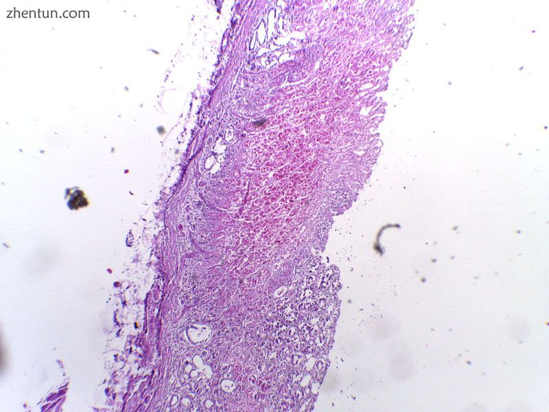 Micrograph showing erosive gastric ulcer. (H&E stain)