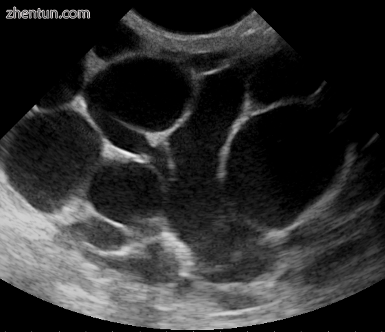 An ultrasound image of puerperal mastitis.png