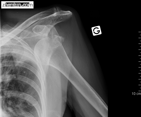 An anterior dislocation of the shoulder