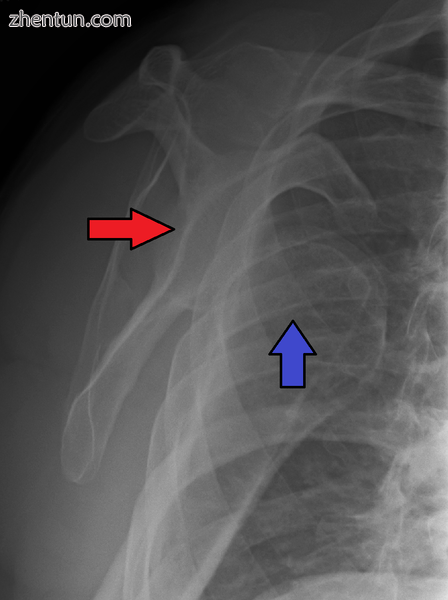 Anterior dislocation of the right shoulder. Y view X ray.