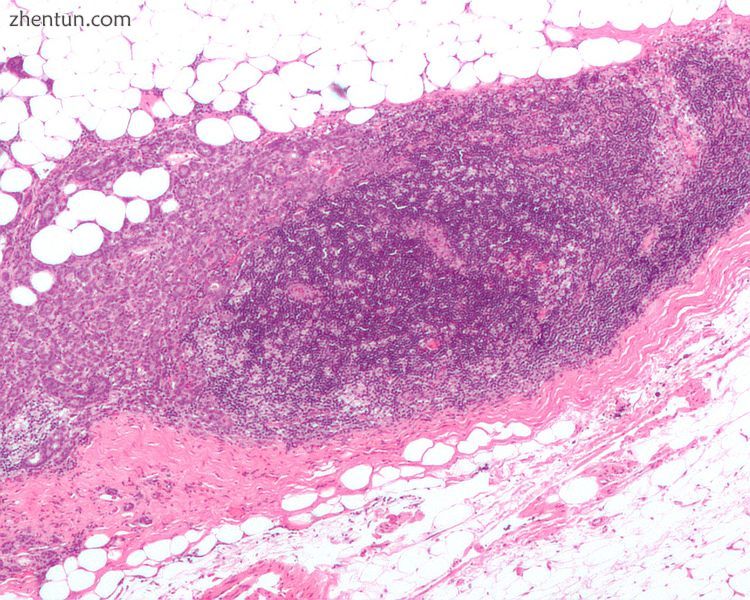 A micrograph showing an adenocarcinoma of the breast (dark pink) in a lymph node (purple) and extend ...