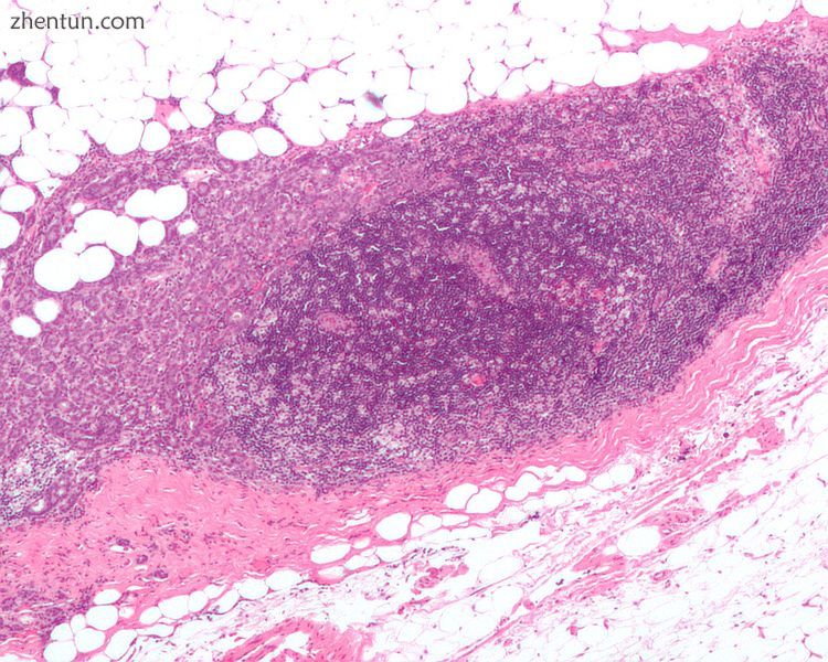 A micrograph showing an adenocarcinoma of the breast (dark pink) in a lymph node (purple) and extend ...