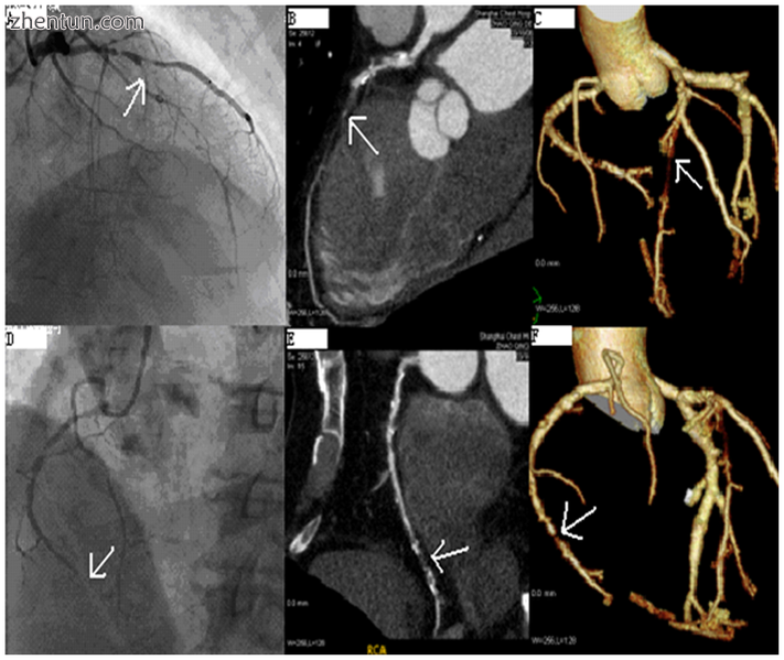 Angiography (left) and CT (middle and right) of chronic total occlusion lesions at the left anterior ...