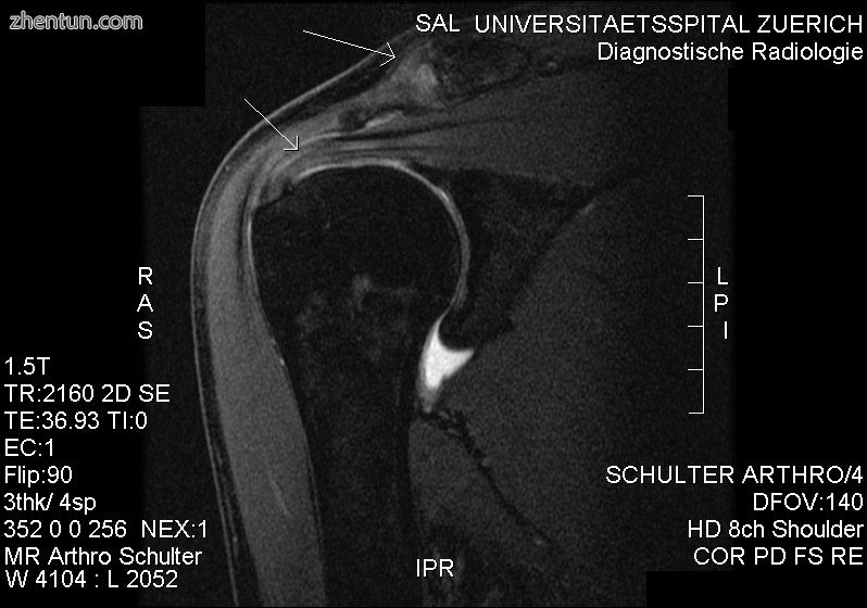 MRI showing subacromial impingement with partial rupture of the supraspinatus tendon. However, no re ...