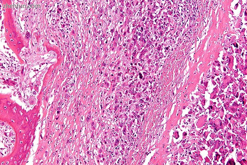 Micrograph of an osteosarcoma, a malignant primary bone tumor.