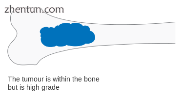 Stage 2A bone cancer