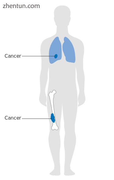 Stage 3 bone cancer