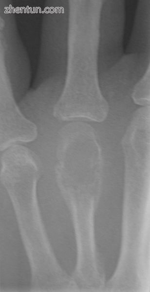 X-ray of a giant cell bone tumor in the head of the 4th metacarpal of the left hand.