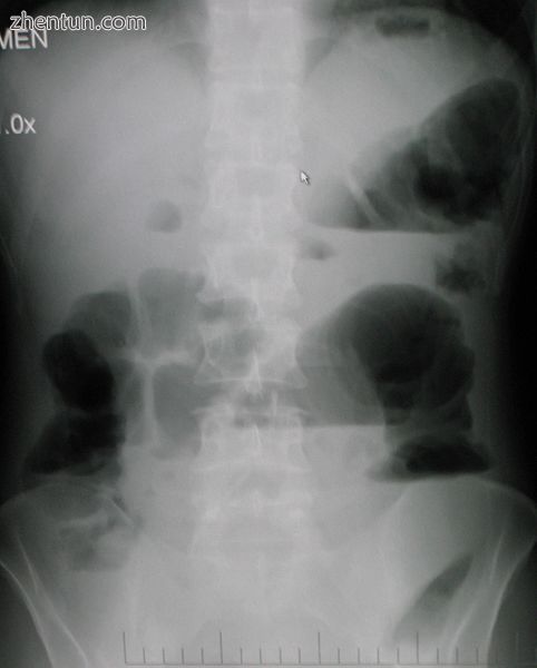 Upright abdominal X-ray demonstrating a small bowel obstruction. Note multiple air fluid levels.