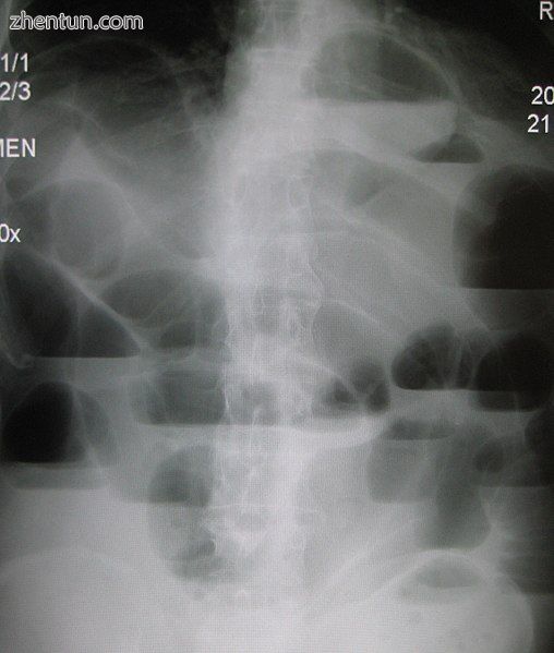 Upright abdominal X-ray demonstrating a small bowel obstruction. Note multiple air fluid levels.