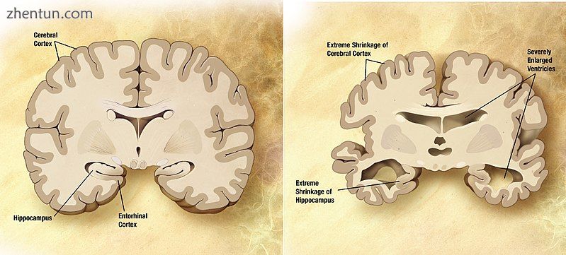 Comparison of a normal aged brain (left) and a brain affected by Alzheimer's disease (right).