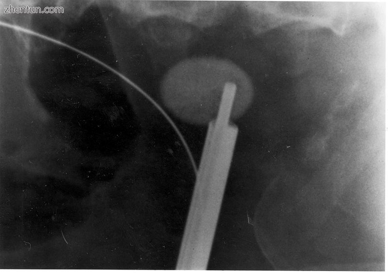 A kidney stone at the tip of an ultrasonic stone disintegration apparatus