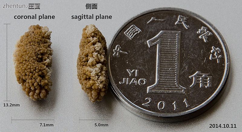 A lenticular kidney stone, excreted in the urine