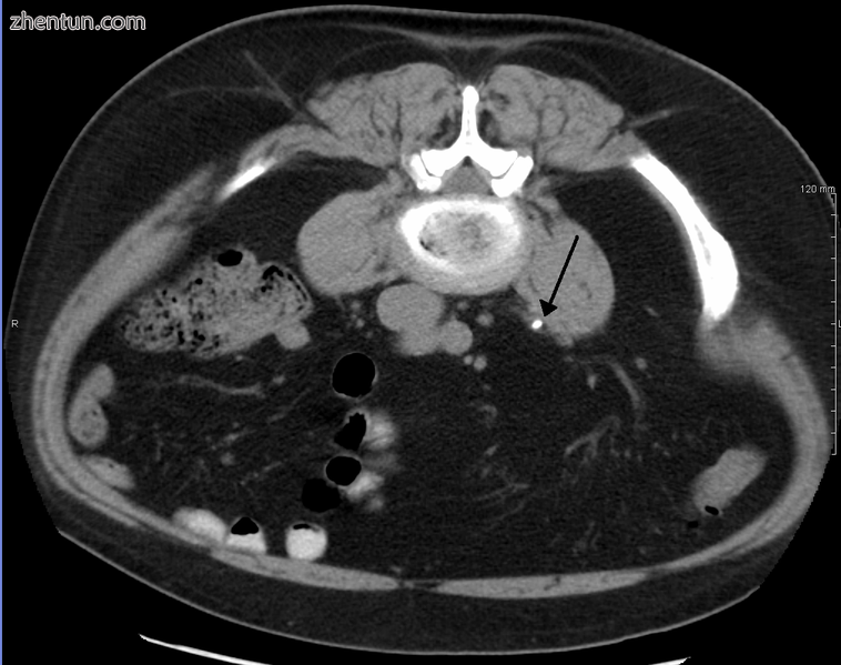 Axial CT scan of abdomen without contrast, showing a 3-mm stone (marked by an arrow) in the left pro ...
