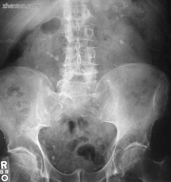 Bilateral kidney stones can be seen on this KUB radiograph. There are phleboliths in the pelvis, whi ...