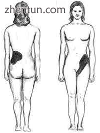 Diagram showing the typical location of renal colic, below the rib cage to just above the pelvis