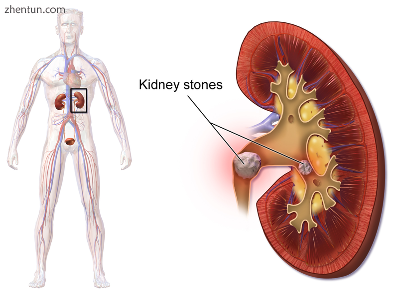 Illustration of kidney stones