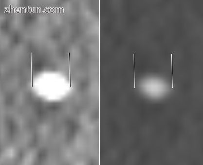 Measurement of a 5.6 mm large kidney stone in soft tissue versus skeletal CT window.