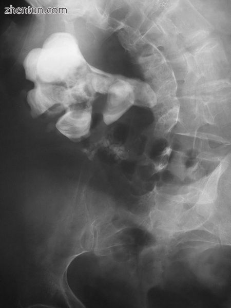Radiograph showing a large staghorn calculus involving the major calyces and renal pelvis in a perso ...