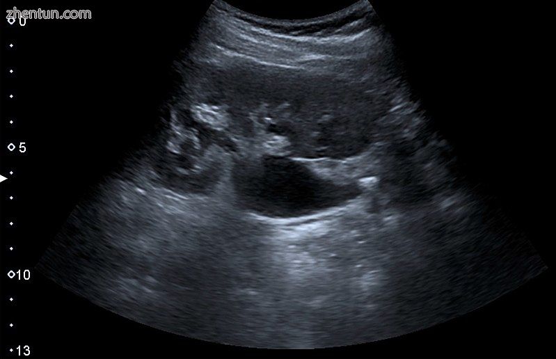 Renal ultrasonograph of a stone located at the pyeloureteric junction with accompanying hydronephros ...