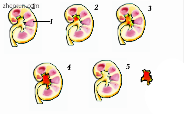 Small crystals formed in the kidney. The most common crystals are made of calcium oxalate and they a ...