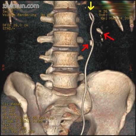 Three-dimensional reconstructed CT scan image of a ureteral stent in the left kidney (indicated by y ...