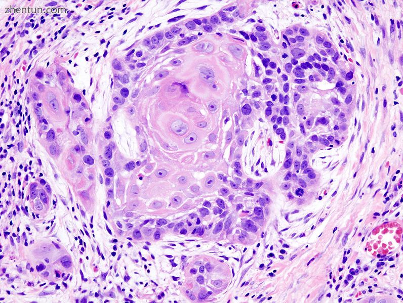 Histopathologic appearance of a well differentiated squamous cell carcinoma specimen. Hematoxylin-eo ...