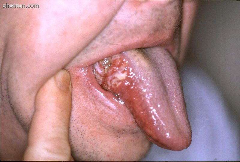 Oral cancer on the side of the tongue, a common site along with the floor of the mouth