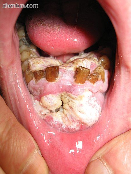 Oral cancer in a 40-year-old male smoker