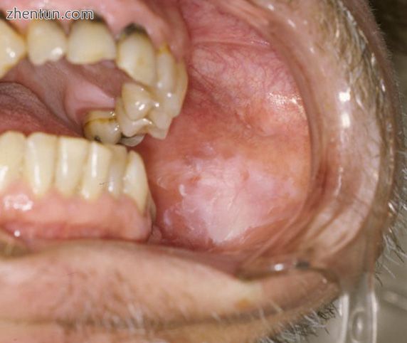 Oral leukoplakia on the buccal mucosa.