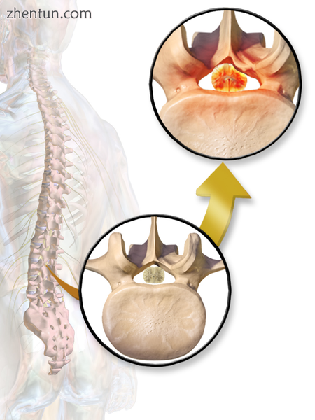 Drawing showing spinal stenosis with spinal cord compression