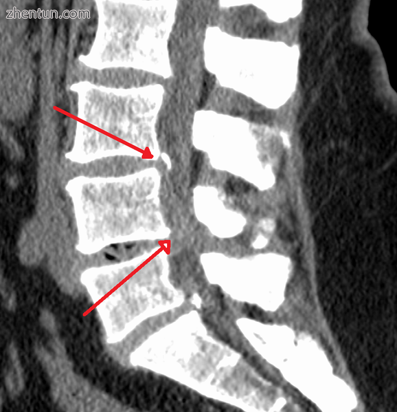 Moderate to severe spinal stenosis at the levels of L3/4 and L4/5