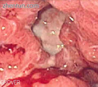 Endoscopic image of gastric ulcer, biopsy proven to be gastric cancer.